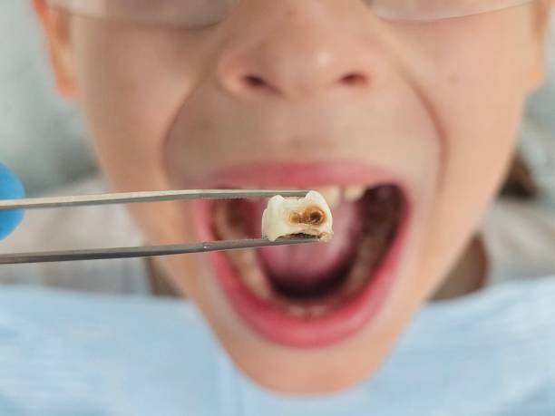 Best Emergency Tooth Extraction in Mountain View, CA