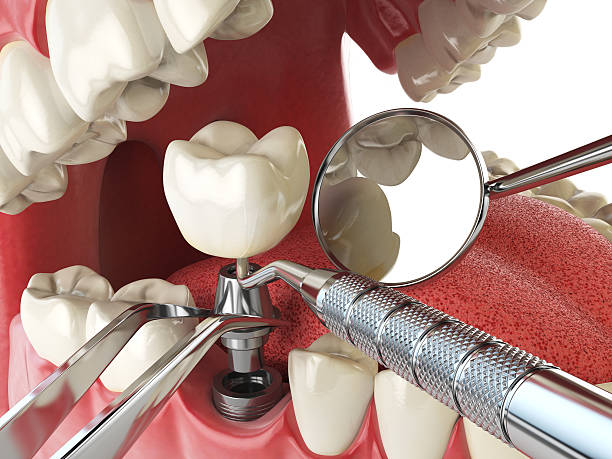 Best Urgent Care for Lost Fillings or Crowns in Mountain View, CA